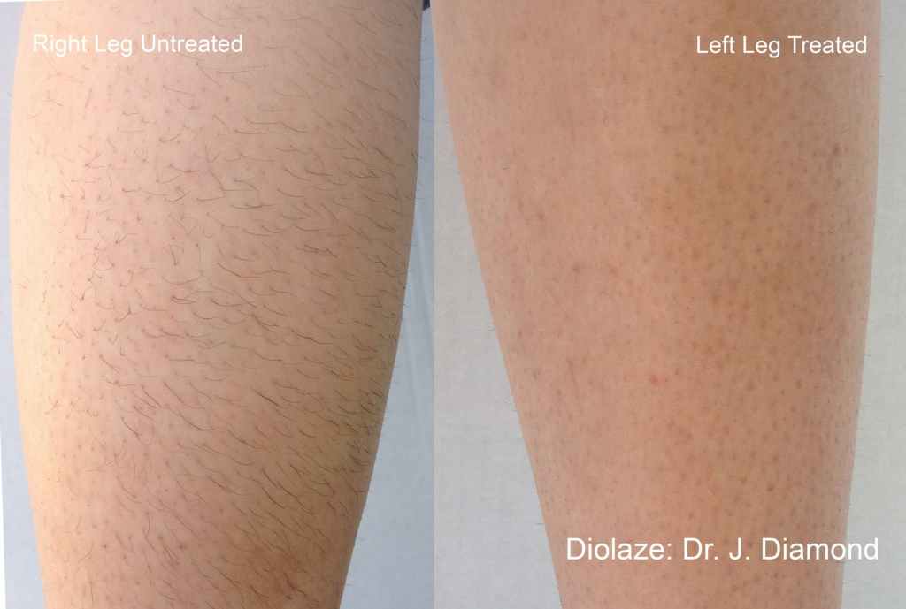 before and after of laser hair removal